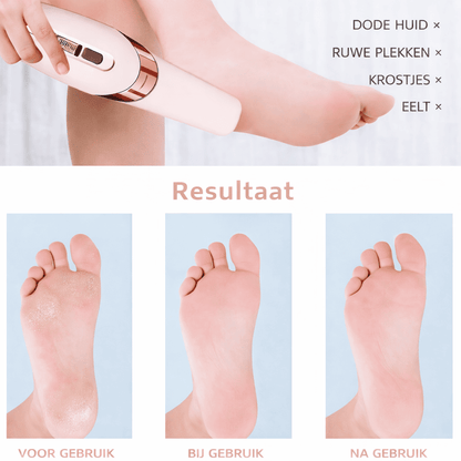SOLEA™ PediCare - Verwijder eelt en krijg zijdezachte voeten gewoon thuis